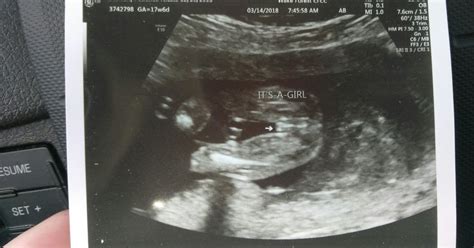 Baby Gender Ultrasound Near Me Get More Anythink S