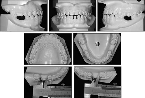 Protraction Of Mandibular Second And Third Molars Into Missing First