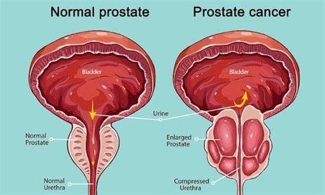 How Long To Recover From Prostate Cancer Surgery Bobby Vincent S Blog