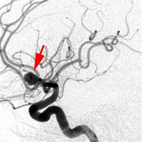 Cerebral Angiogram Shows The Aneurysm Arrows That Was Responsible For