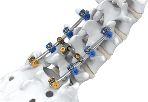 Arsenals Innovative Spinal Fixation System For Surgery