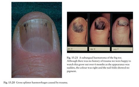 The Nails Effects Of Trauma