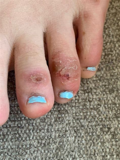 One such symptom, purple or red lesions on the toes. 'COVID Toes' May Be a New, Rare Symptom Of Novel Coronavirus, Doctors Say - chicagodrawbridges