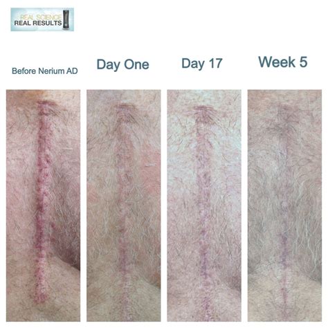 My Dads Open Heart Surgery Scar On Nerium Ad Go To Debbylovesnerium