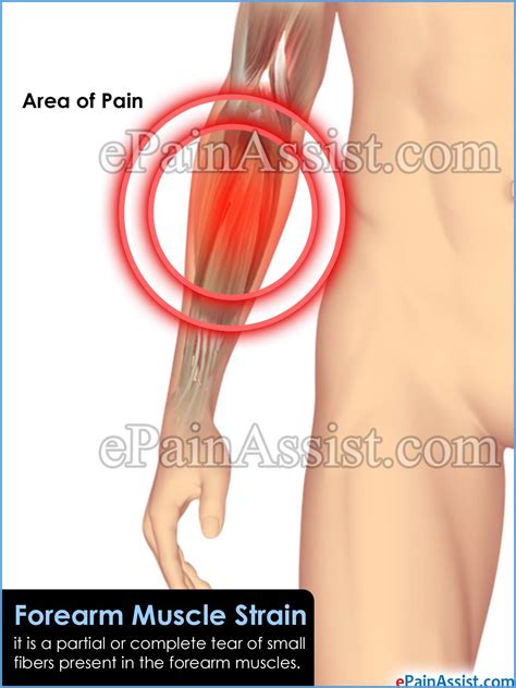Arms full of tendons, tendons on the forearm. Forearm Muscle Strain|Causes|Symptoms|Treatment|Recovery ...
