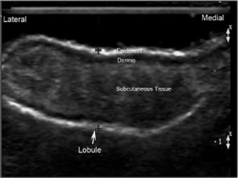 Sonography Of The Ear Pinna Wortsman 2008 Journal Of Ultrasound