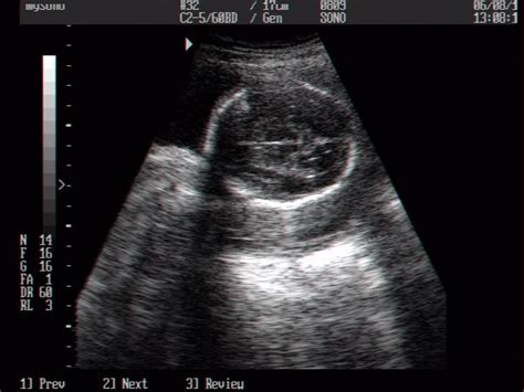 Ultrasound Images • Fetal Head B Mode Echogramm №9