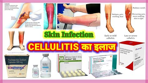 Cellulitis Cellulitis Treatment Cellulitis Of The Legs Cellulitis