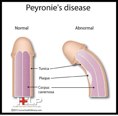 Peyronies Disease Male Reproductive System Pinterest