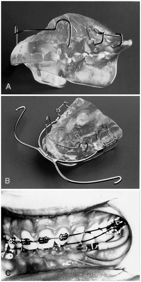 Initial Effects Of Treatment Of Class Ii Malocclusion With The Herren