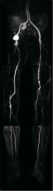 Contrast Enhanced Mra Of The Peripheral Vasculature Magnetic Resonance