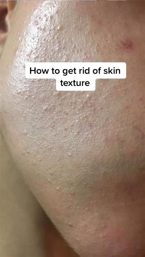 How To Get Rid Of Skin Texture Natural Skin Care Skin Care Routine