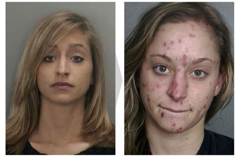 18 Disturbing Before And After Pictures Of Faces Transformed By Drug