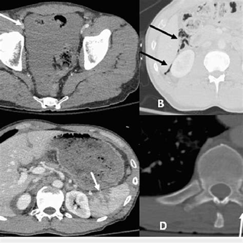 Postcontrast Ct Shows A Large Amount Of Free Fluid In The Abdomen And