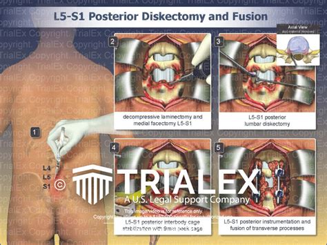 L5 S1 Posterior Diskectomy And Fusion Trialexhibits Inc