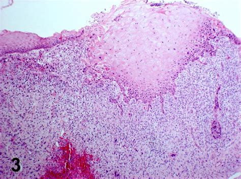 Pathology Outlines Conventional Squamous Cell Carcinoma