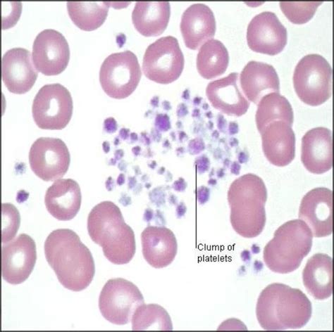 Platelet Clumping On Smear Due To Edta In Tube Pseudothrombocytopenia