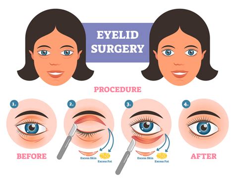Best Eyelid Surgery Specialist In Dubai Eye Bag Removal And Eye