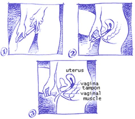 Educational diagram of how to insert a tampon. Tampons: Using Your First Tampon | Center for Young Women's Health