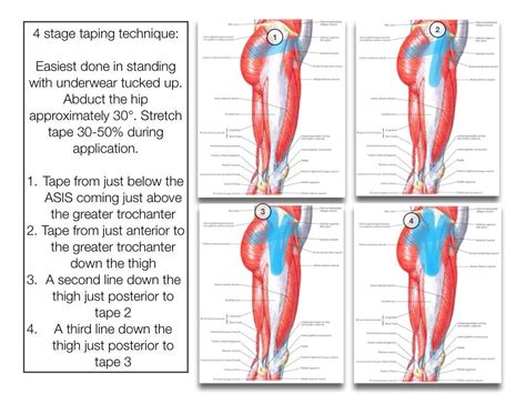 Gluteal Tendinopathy Kinesiology Taping Hip Workout Hip Flexor