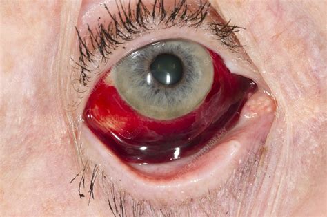 Subconjunctival Haemorrhage Of The Eye Stock Image C0168224