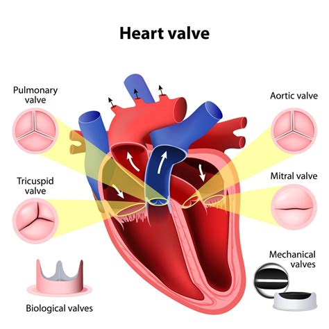 Types Of Mechanical Heart Valves Dr Ciuffo Heart Surgery