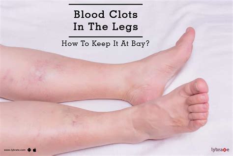 Blood Clots In The Legs How To Keep It At Bay By Dr Alok Umre