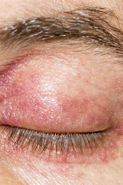 Eyelid Dermatitis Treatment Symptoms And Causes