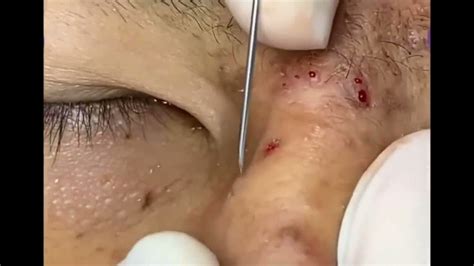05 Blackheads On Nose And Forehead Best Pimple Popping Videos Youtube