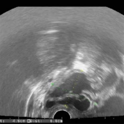 Transvaginal Ultrasound Multiloculated Cystic Mass In The Right Ovary