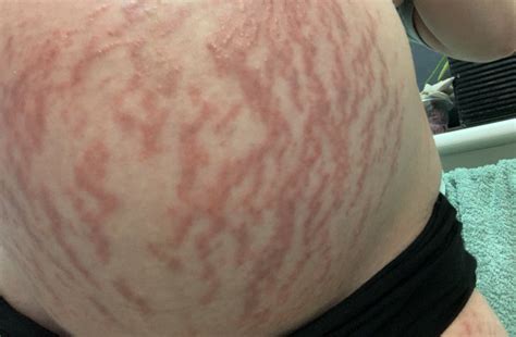 Itchy Inflamed Irritated Stretch Marks Babycenter