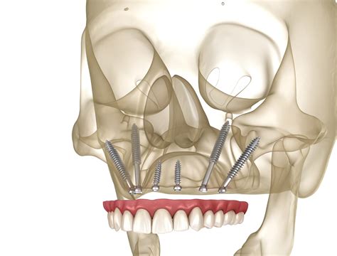 Zygomatic Implants Dental Solutions