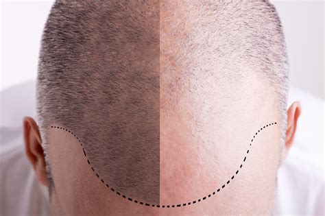What Makes A Good Candidate For Hair Transplant Surgery Ape To Gentleman
