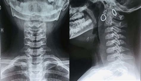 Post Operative X Ray Soft Tissue Neck Anteroposterior And Lateral View