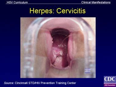 Cervicitis Clinical Presentation History Physical Examination