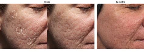 Bellafill Acne Scar Treatment Before And Afters Total Dermatology