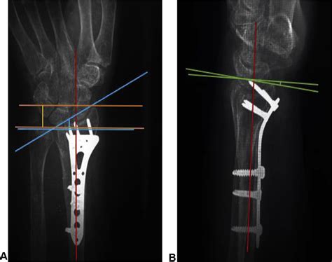 Z Corrective Osteotomy In Malunited Extra Articular Fractures Of Distal