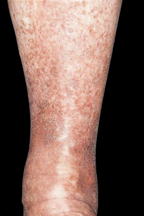 Varicose Eczema Photograph By Dr P Marazziscience Photo Library