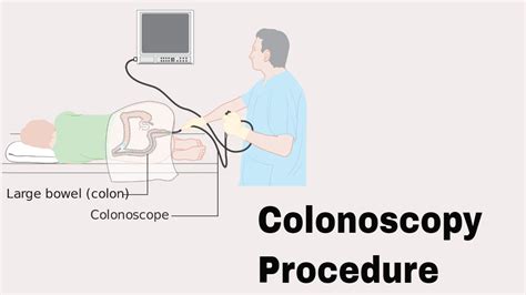 Colorectal surgeons will also perform colonoscopy in other words, a colonoscopy performed by any of these types of doctor reduces the risk for colorectal cancer death—but this study suggests. Colonoscopy Procedure || Coloniscopy Biopsy || How to ...