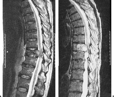 Spinal Cord Compression Secondary To Neoplastic Disease Epidural