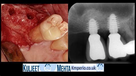 Internal Sinus Lift And Dental Implants Youtube