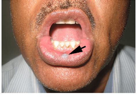 Clinical Photograph Showing Whitish Patch Seen On The Lower Lip