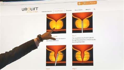 Health Check Urolift Prostate Treatment