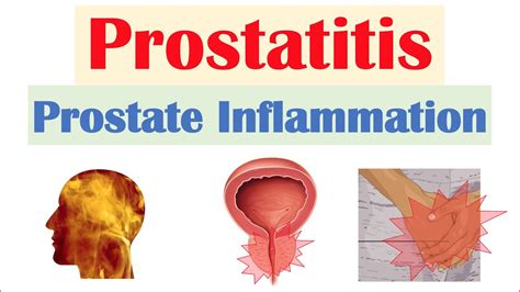 prostatitis prostate inflammation different types causes signs and symptoms diagnosis