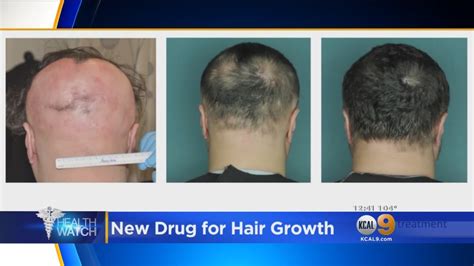 Fda Approves Hair Loss Drug Youtube