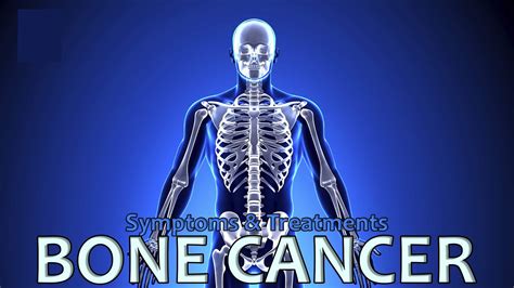 Bone Cancer Causes Types Signs Symptomstreatment