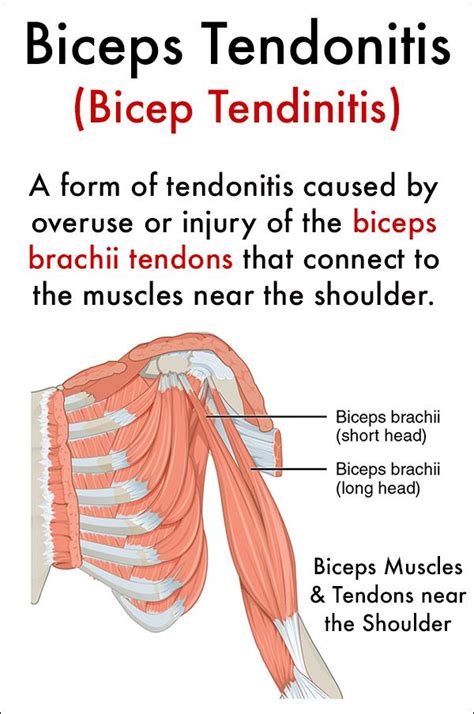 What Is Biceps Tendonitis Bicep Tendinitis In 2021 Bicep