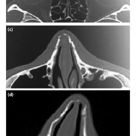 Nasal Fracture X Ray