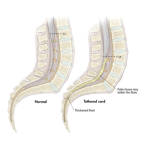 Tethered Spinal Cord Syndrome What You Need To Know Hubpages