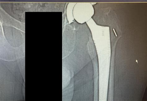 Case Study Management Of Left Hip Periprosthetic Fracture With A Loose